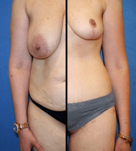 Mommy Makeover Plastic Surgery DC