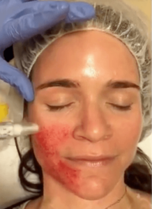 Micro-needling with PRP
