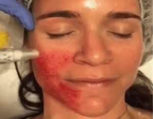 micro-needling with PRP