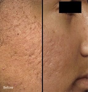Micro-needling with PRP