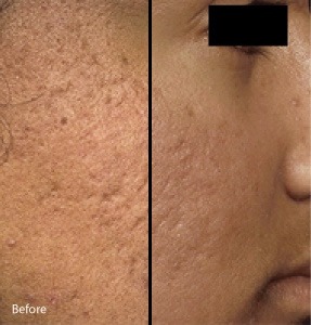 Micro-needling with PRP