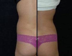 Liposuction DC