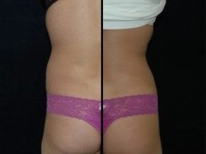 Liposuction DC