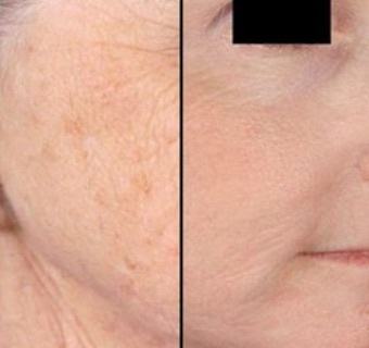 Microneedling with PRP