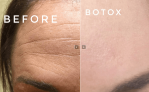 Washington DC Botox