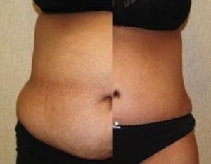 Tummy Tuck