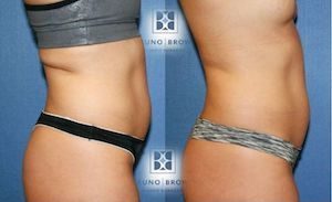 Sculpsure DC