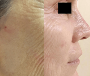 micro-needling with PRP