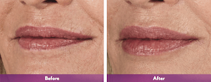 Dermal Fillers