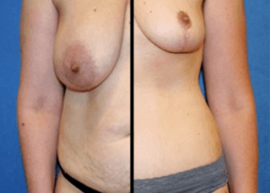 Washington, DC Moms: Regain Your Confidence with a Mommy Makeover