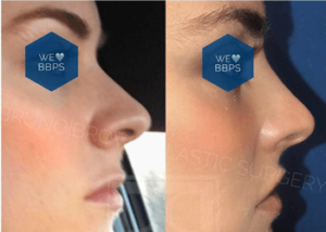 Liquid Rhinoplasty DC