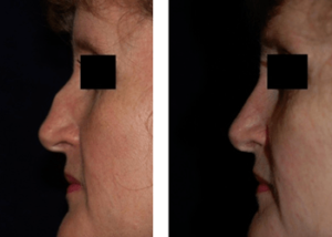 Nose Job DC