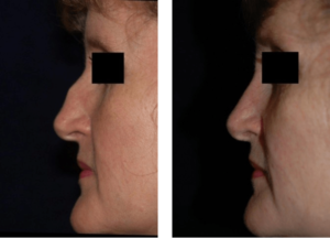 Rhinoplasty DC Nose Job Before and After