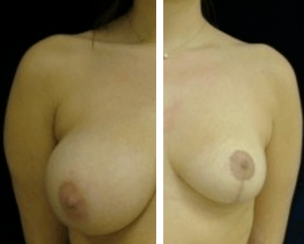Breast Reduction DC