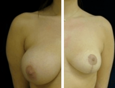 Breast Reduction Surgery DC
