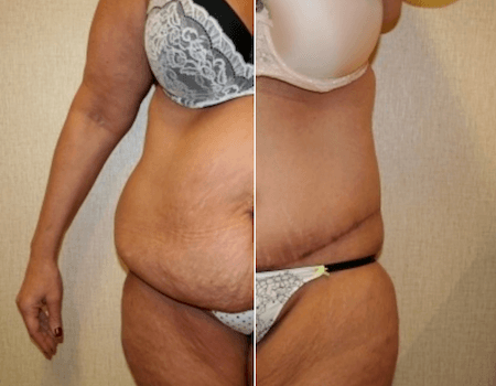 Tummy Tuck Annandale, VA