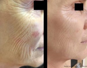 Microneedling with PRP