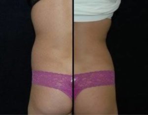 Liposuction in Dulles, VA