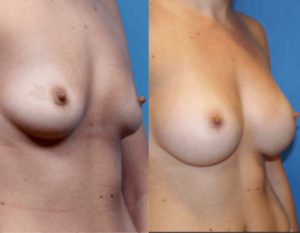 Breast Implants DC