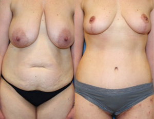 The Ultimate Guide to DC Tummy Tucks and Mommy Makeovers