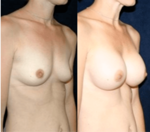 Breast Augmentation in DC