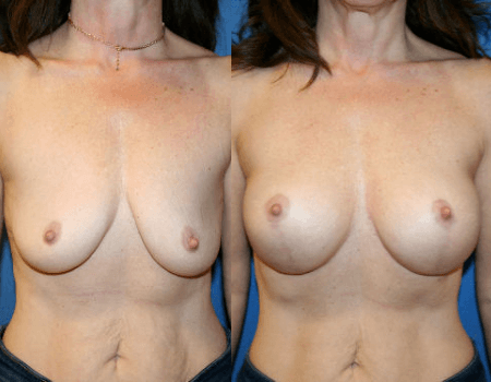 Elevating Confidence: A Comprehensive Guide to Breast Enhancement with Bruno|Brown Plastic Surgery in Chevy Chase, MD