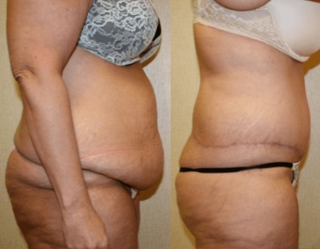 Tummy Tuck Bethesda