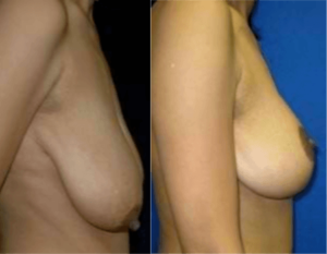 Breast Lift in DC