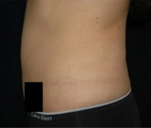 Laser Lipo