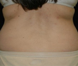 Laser Lipo