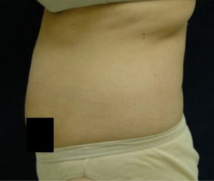 Laser Lipo