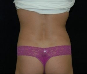 Laser Lipo