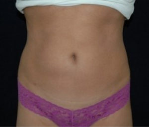 Laser Lipo