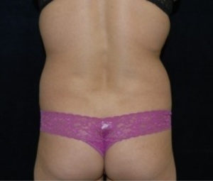 Laser Lipo