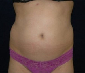 Laser Lipo