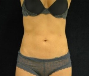 Laser Lipo