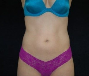Laser Lipo