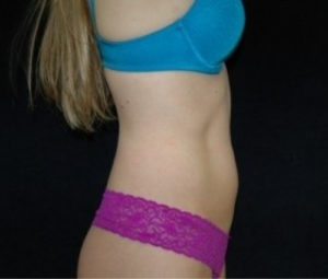 Laser Lipo