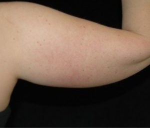 Laser Lipo