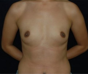 Breast Augmentation