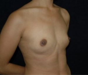 Breast Augmentation