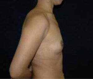 Breast Augmentation