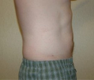 Laser Lipo