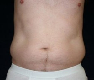 Laser Lipo
