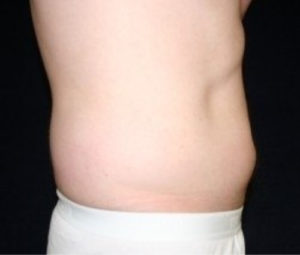 Laser Lipo