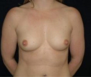 DC Breast Augmentation