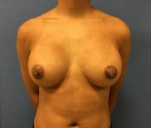 After Breast Augmentation