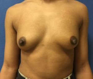 Before Breast Augmentation