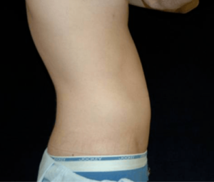 Laser Lipo