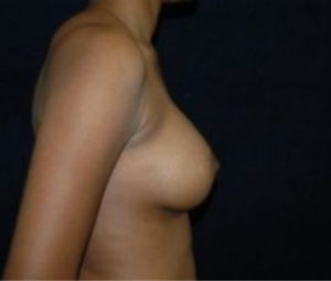 DC Breast Augmentation
